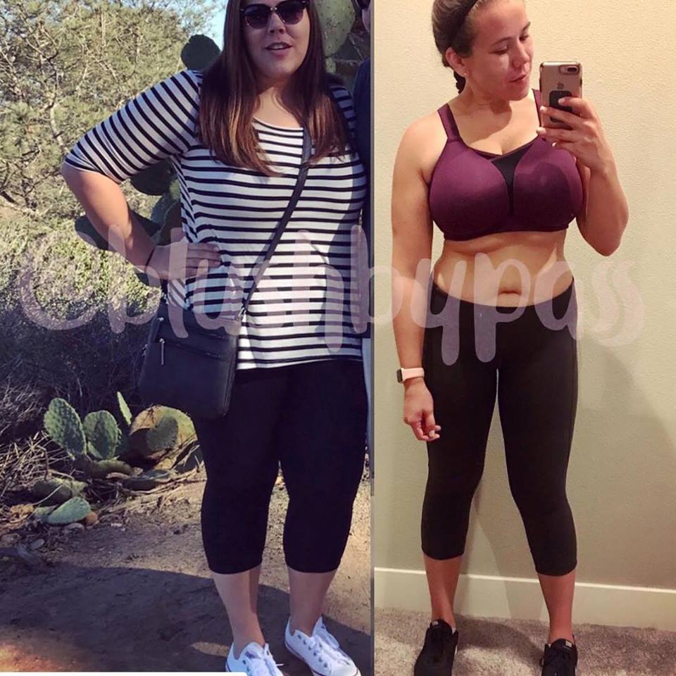 Medical Weight Loss in Tulsa Before & After Photos