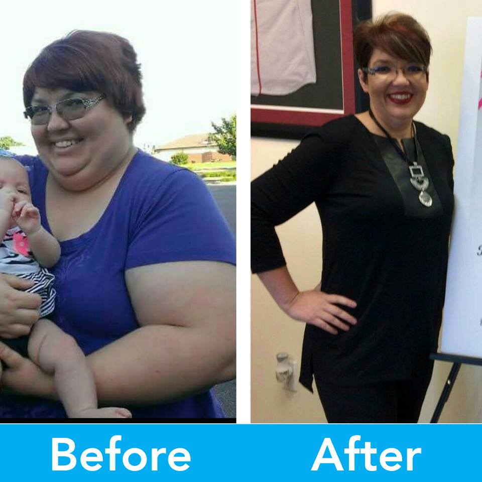 Medical Weight Loss in Tulsa Before & After Photos